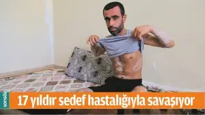 17 YILDIR SEDEF HASTALIĞIYLA SAVAŞIYOR