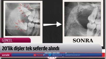 20&rsquo;lik dişler tek seferde alındı