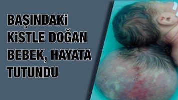 BAŞINDAKİ KİSTLE DOĞAN BEBEK, HAYATA TUTUNDU