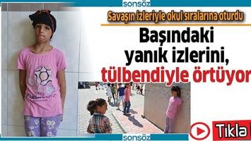 BAŞINDAKİ YANIK İZLERİNİ, T&Uuml;LBENDİYLE &Ouml;RT&Uuml;YOR
