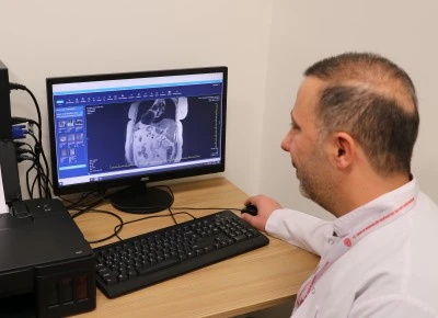 İ&ccedil; organları ters olan hastanın safra kesesindeki taş ERCP işlemiyle alındı