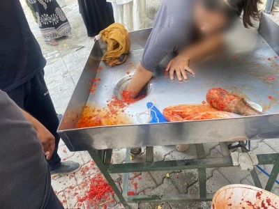 Sal&ccedil;a makinesine elini kaptıran gen&ccedil; kız ameliyatla kurtarıldı