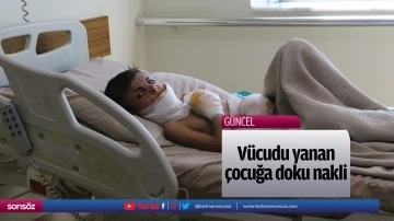 V&uuml;cudu yanan &ccedil;ocuğa doku nakli
