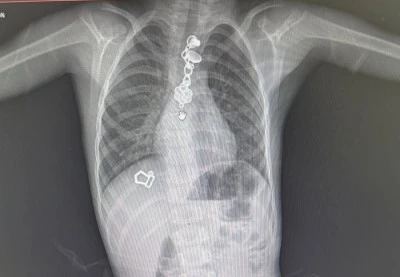 Yemek borusuna ka&ccedil;an cisimlerden operasyonla kurtuldu