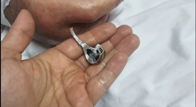 Yoğun bakımda y&uuml;z&uuml;k operasyonu